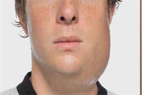 Man with a goiter on his neck and jaw from mumps